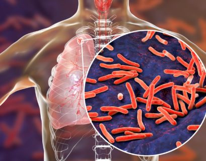 La tuberculosis