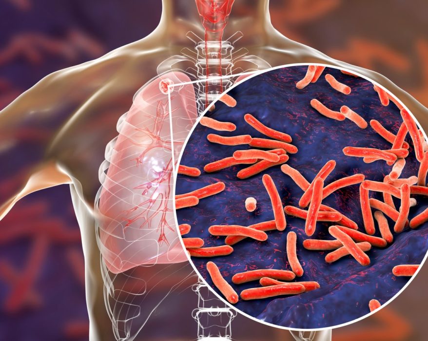 La tuberculosis